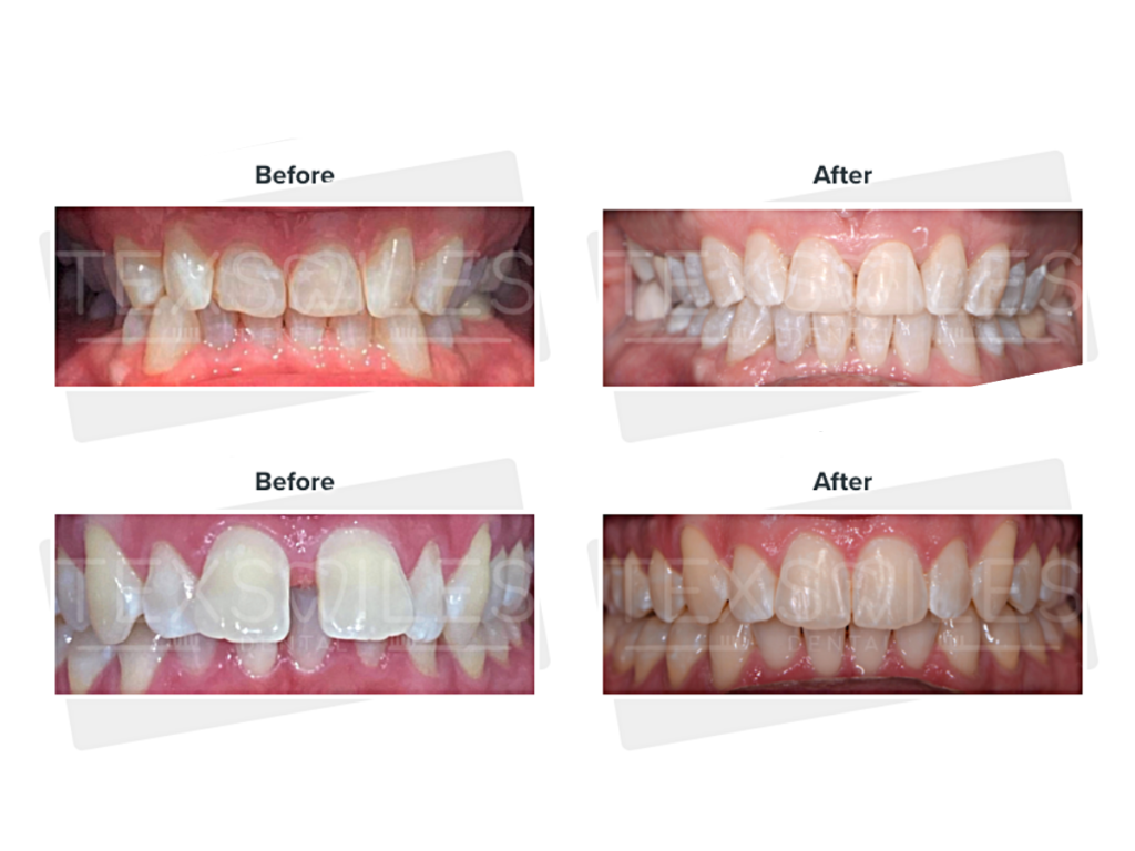 Invisalign before and after results with TexSmiles Dental