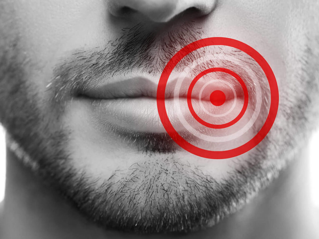 The lower half of a man's face with a red target over the corner of his lips signaling a cold sore