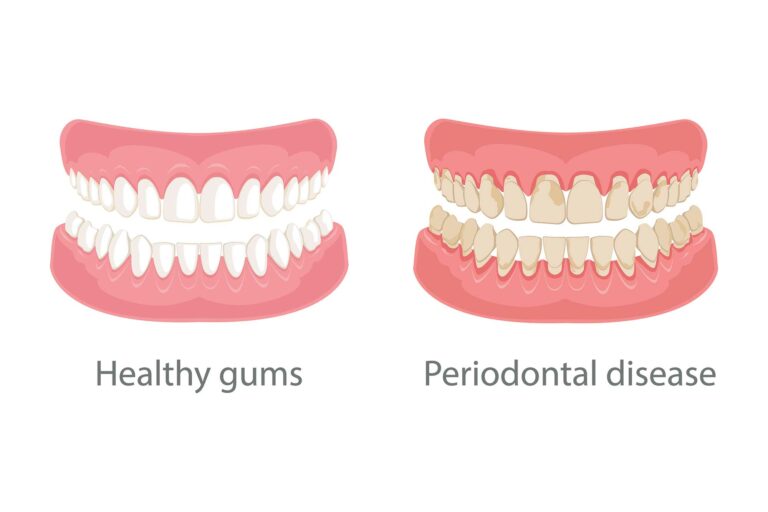 gum disease before and after if untreated