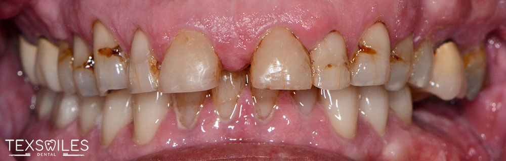 TexSmiles Dental