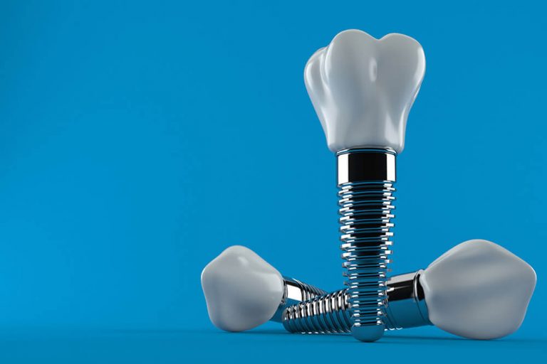 Are Dental Implants Safe?